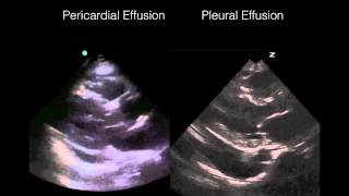 Cardiac Ultrasound Pericardial vs Pleural effusion [upl. by Ihel]