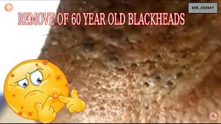 REMOVE OF 60 YEAR OLD BLACKHEADSPart1 [upl. by Inaffyt]