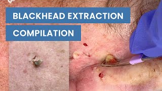 Extraction Satisfaction Blackhead Removal  CONTOUR DERMATOLOGY [upl. by Notyal]