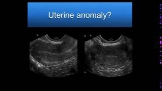 How long does it take for uterus to go back to normal after delivery DrHimani Sharma of Cloudnine [upl. by Ialda]