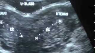 Bicornuate Uterus Case Study [upl. by Sigfried]