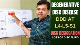 Degenerative Disc Disease DDD L4 L5 L5 S1Disc Desiccation Disc Degeneration Disease Treatment [upl. by Elijah650]