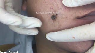 Removing Years Old Blackheads On a Mans Face Easily SS01E01 [upl. by Bagger263]