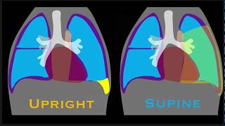 Pleural Effusion Explained by Prometheus Lionhart MD [upl. by Llenrahc]