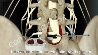 Lumbar Fusion of L5 S1 Posterior [upl. by Dachia]