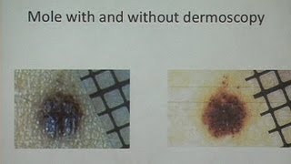 Melanoma and Nonmelanoma Skin Cancer [upl. by Aliuqahs]