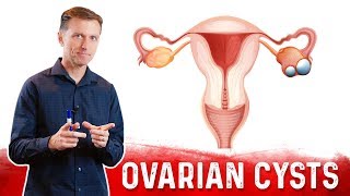 Ovarian Cysts Causes Symptoms amp Natural Treatment – DrBerg [upl. by Nwahsyd]