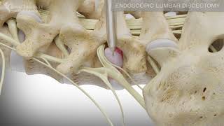 Endoscopic Lumbar Discectomy  Spine Institute of North America [upl. by Ehsrop]