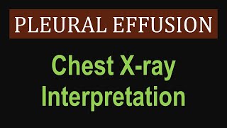 Pleural Effusion  Chest Xray Interpretation [upl. by Akiehsal]