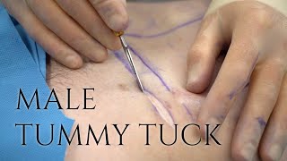 Male Tummy Tuck  Amazing After Results  Barrett Plastic Surgery in Beverly Hills [upl. by Asen]