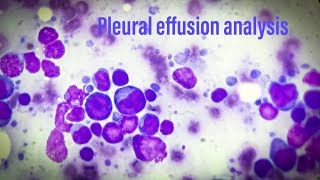 Pleural effusion analysis [upl. by Koerner650]