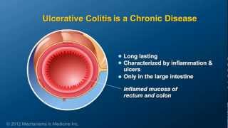 Inflammatory Bowel Disease  Pathophysiology and Complications [upl. by Willumsen]