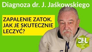 dr Jerzy Jaśkowski  Leczenie zapalenia zatok [upl. by Nirret880]