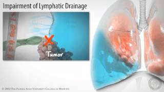 Pleural Space Part 3 of 3 Pleural Effusions HD [upl. by Annaerdna]