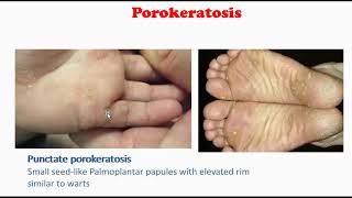 Porokeratosis [upl. by Aynwad]