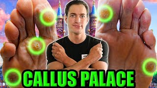 Callus Palace Cutting Out Multiple Painful Calluses [upl. by Yorgerg]