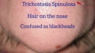 Hair removal on the nose by Laser  Trichostasis Spinulosa [upl. by Othilia]