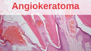 Angiokeratoma of Mibelli  Pathology mini tutorial [upl. by Lindi]