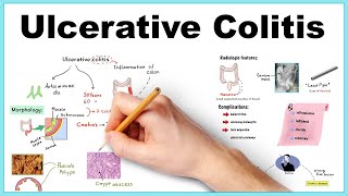 Management of acute severe ulcerative colitis [upl. by Shanta]