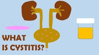 What is Cystitis [upl. by Fabron507]