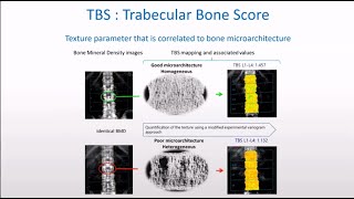 How to use TBS Trabecular Bone Score in combination with BMD in Clinical DXA practice [upl. by Pisano993]