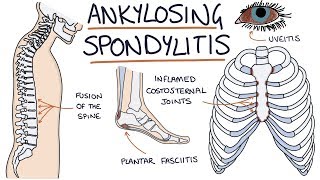 Ankylosing Spondylitis Visual Explanation for Students [upl. by Lukas]