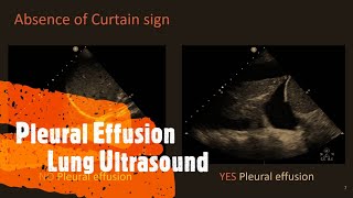 Pleural Effusion Lung Ultrasound Perioperative amp Critical Care POCUS [upl. by Saberio]