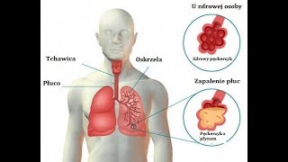 Zapalenie płuc – Objawy i leczenie [upl. by Georgetta]