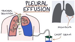 Understanding Pleural Effusions [upl. by Dine]