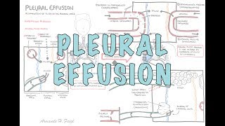 Pleural Effusion DETAILED  pathophysiology signs and symptoms treatment [upl. by Ozner]