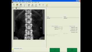 TBS in your clinical practice with GE Lunar DXA [upl. by Cassandra]