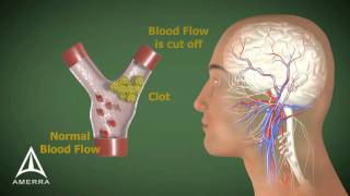 Stroke  3D Medical Animation [upl. by Enilatan]