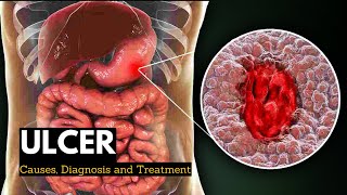 What is Ulcerative Colitis – Causes Symptoms amp Treatment by DrBerg [upl. by Ruzich]