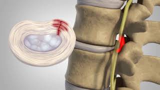 Herniated Disc  Patient Education [upl. by Elocim]