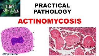 Practical Pathology ACTINOMYCOSIS [upl. by Airrotal]