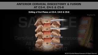 Anterior Cervical Discectomy amp Fusion at C34 C45 amp C56 [upl. by Ayoras]