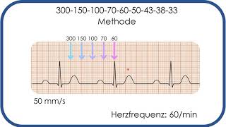 EKGBefundung Herzfrequenz in Sekunden bestimmen 300150100Methode [upl. by Gnirol]