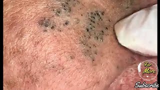 Dr Pop  Deep Blackheads in old Skin removing amp treatment 2020 Part 4 HD [upl. by Chretien51]