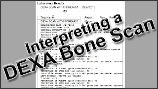 Interpreting a DEXA Bone Scan [upl. by Attenad]