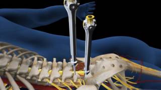 Lumbar Fusion of L5 S1 Animation [upl. by Atsirak]